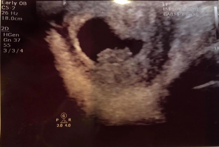 XXXTentacion Baby Sonogram